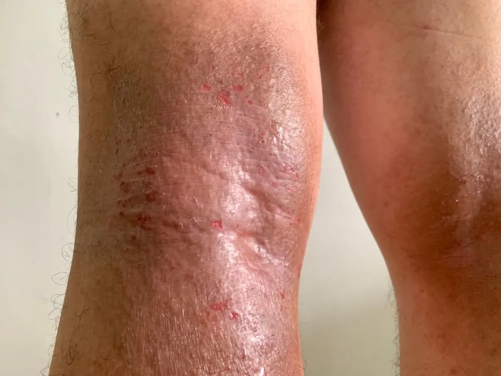 Bệnh viêm da cơ địa ở chân