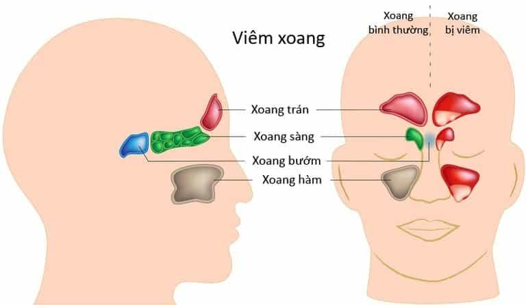 nguyên nhân gây viêm xoang