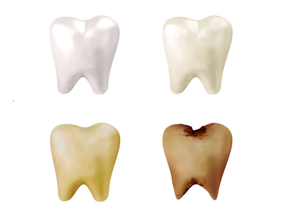 răng bị mục gây hại sức khỏe