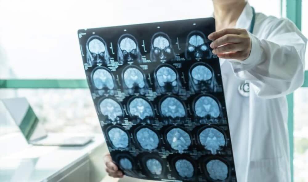 bệnh u não sống được bao lâu