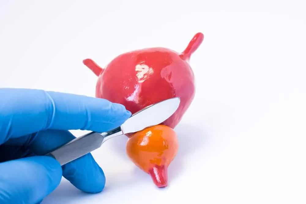 điều trị phì đại tuyến tiền liệt cắt bỏ u xơ