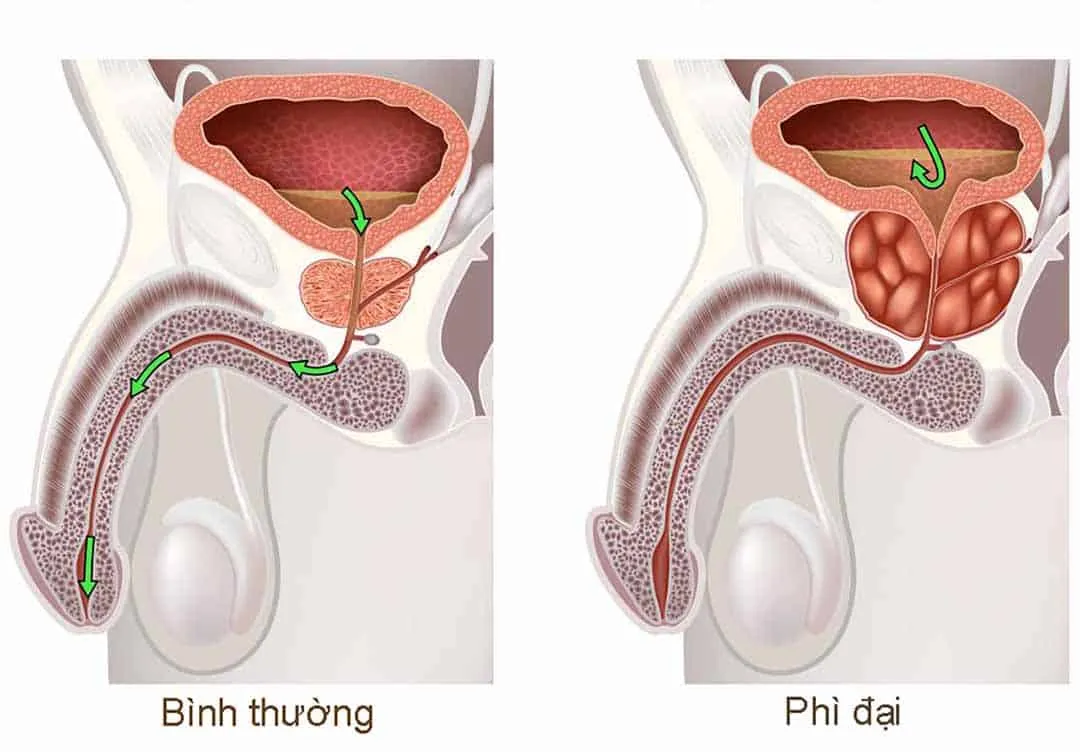 phẫu thuật điều trị phì đại tuyến tiền liệt