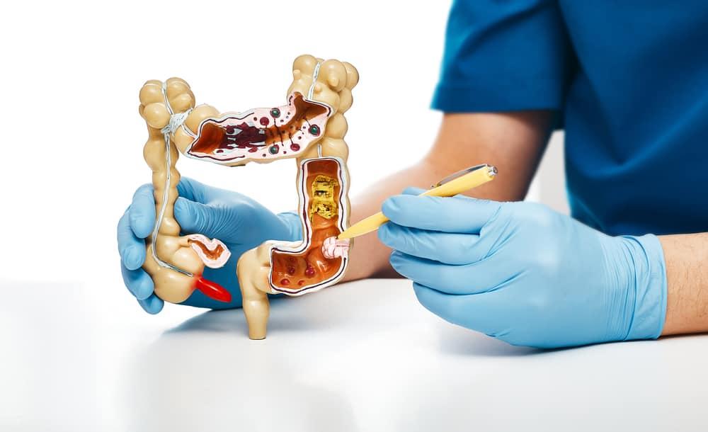 triệu chứng của polyp đại tràng