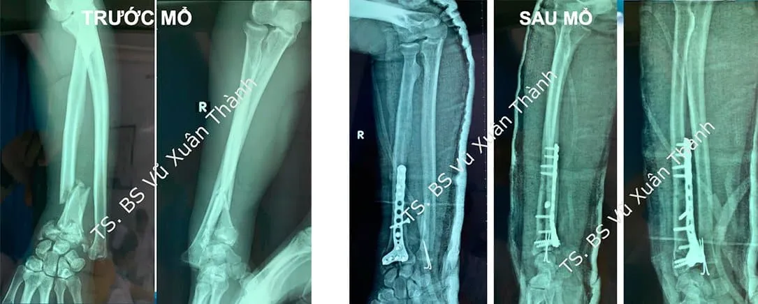 Mổ hở điều trị gãy xương