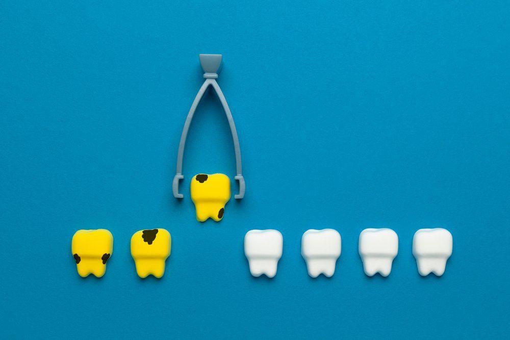 nhổ răng sữa tại nhà