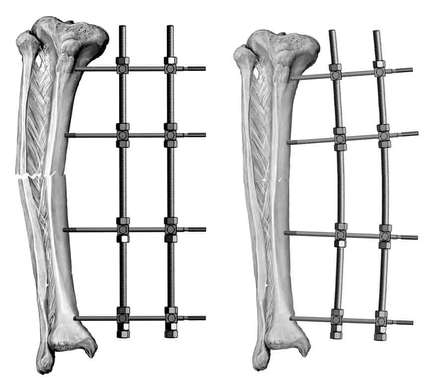 Phương pháp cố định ngoài điều trị gãy xương