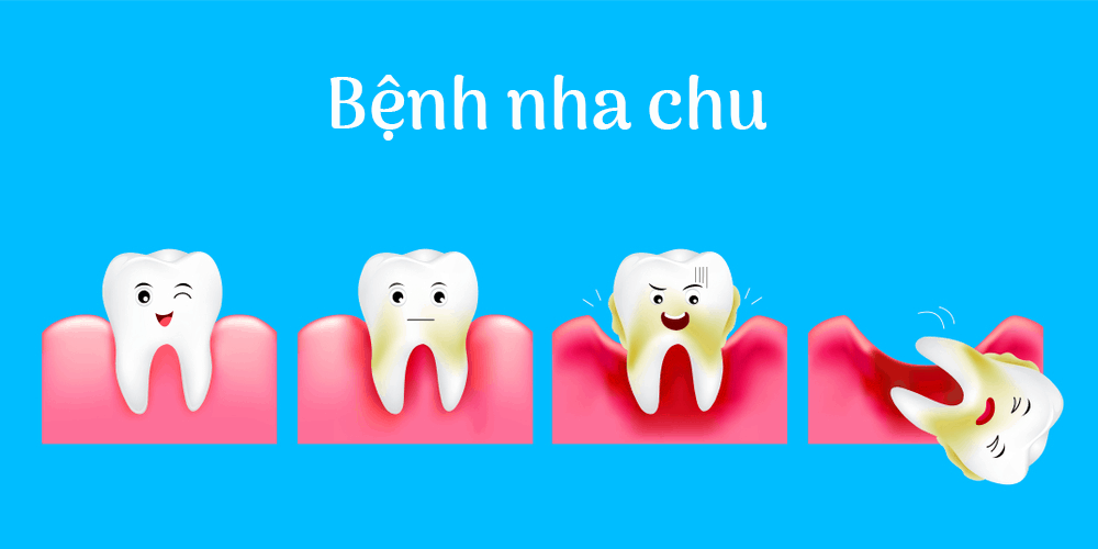 Tiêu xương ổ răng 1