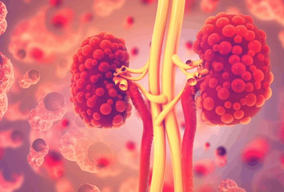 đau thận trái do bệnh thận đa nang