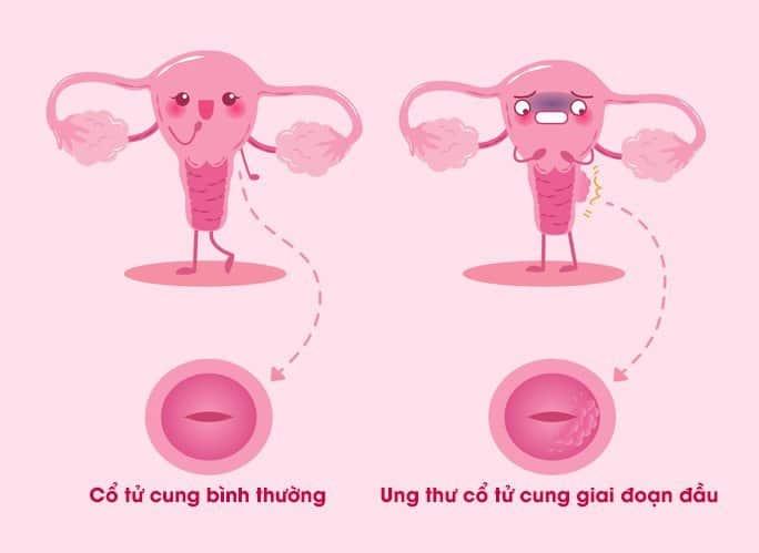 Bệnh ung thư cổ tử cung giai đoạn đầu