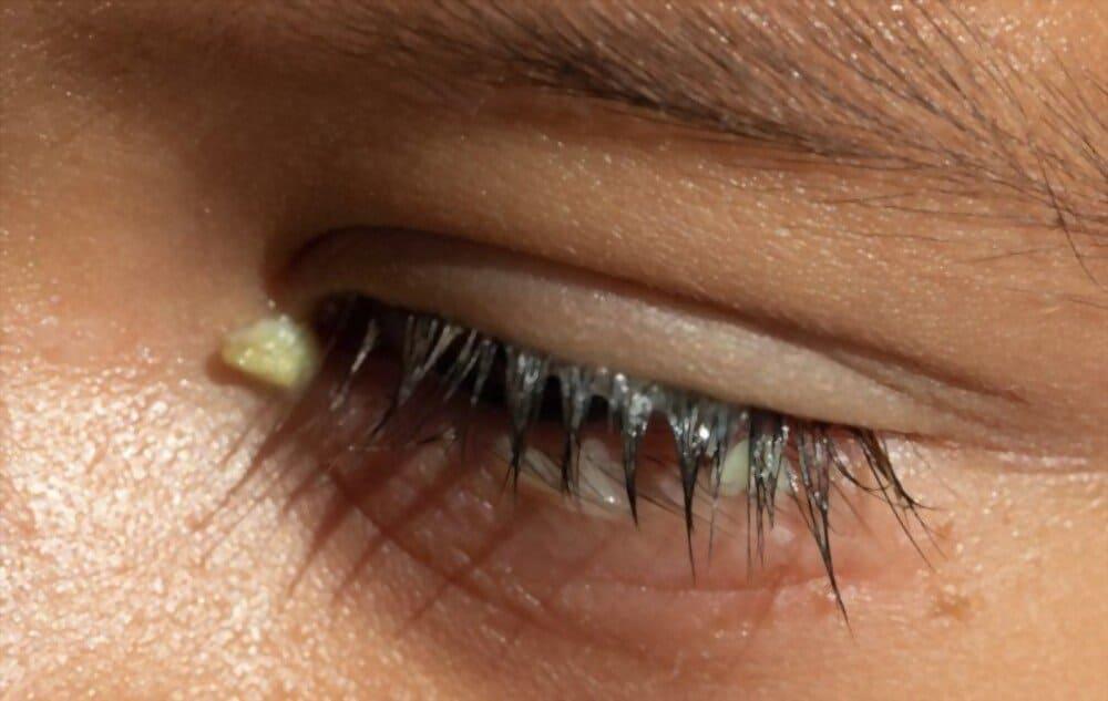 triệu chứng mắt đổ ghèn