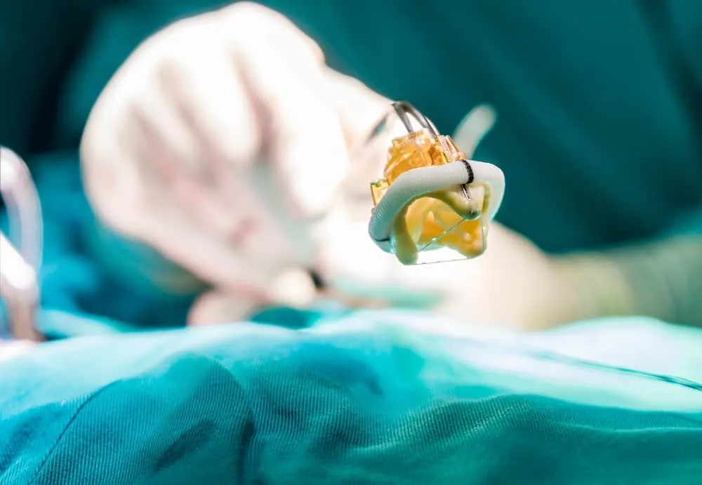 Thay van tim gồm những loại nào