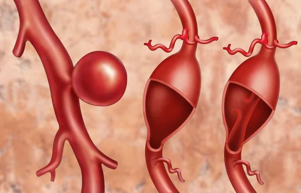 vỡ mạch máu não là gì