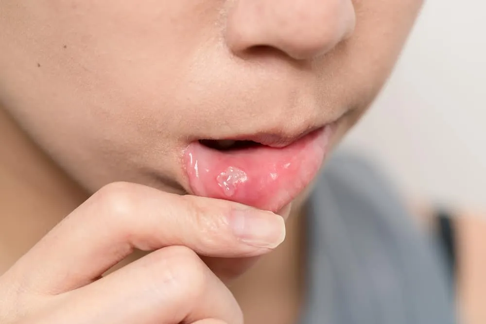 Nổi mụn trong miệng do herpes