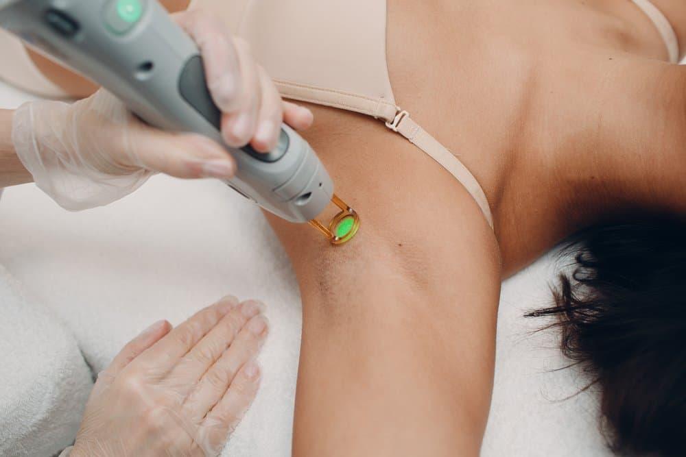 trị thâm nách bằng laser