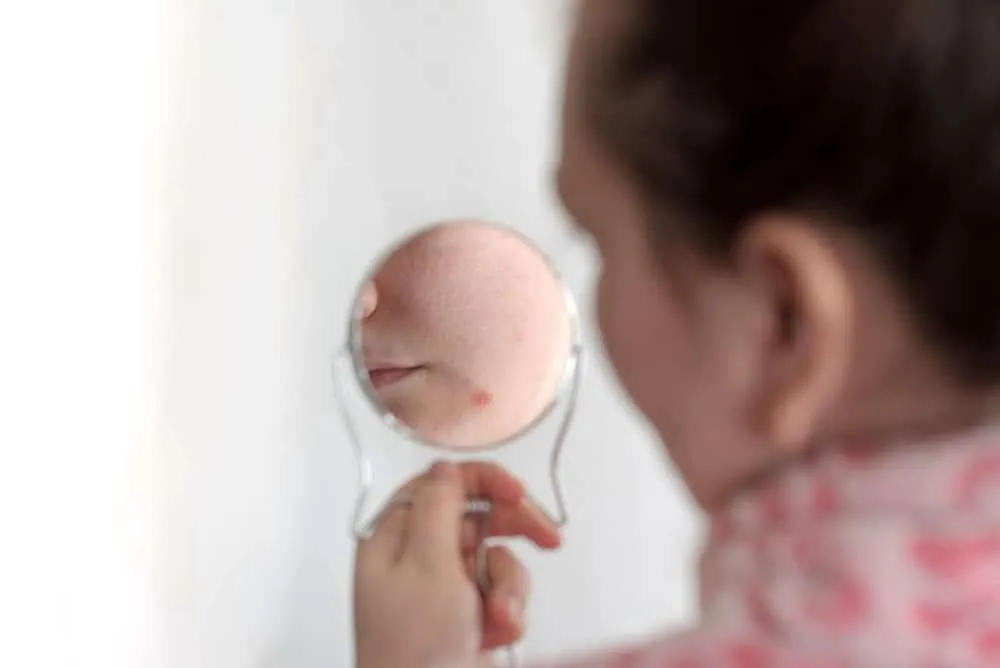 mụn mọc quanh miệng