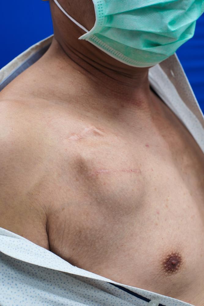 cấy máy tạo nhịp tim