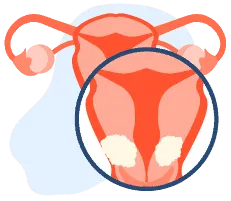 Sàng lọc ung thư cổ tử cung