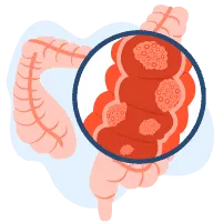 Sàng lọc tầm soát ung thư đại trực tràng