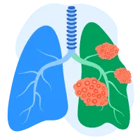 Sàng lọc ung thư phổi