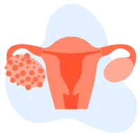 Sàng lọc hỗ trợ tầm soát ung thư buồng trứng