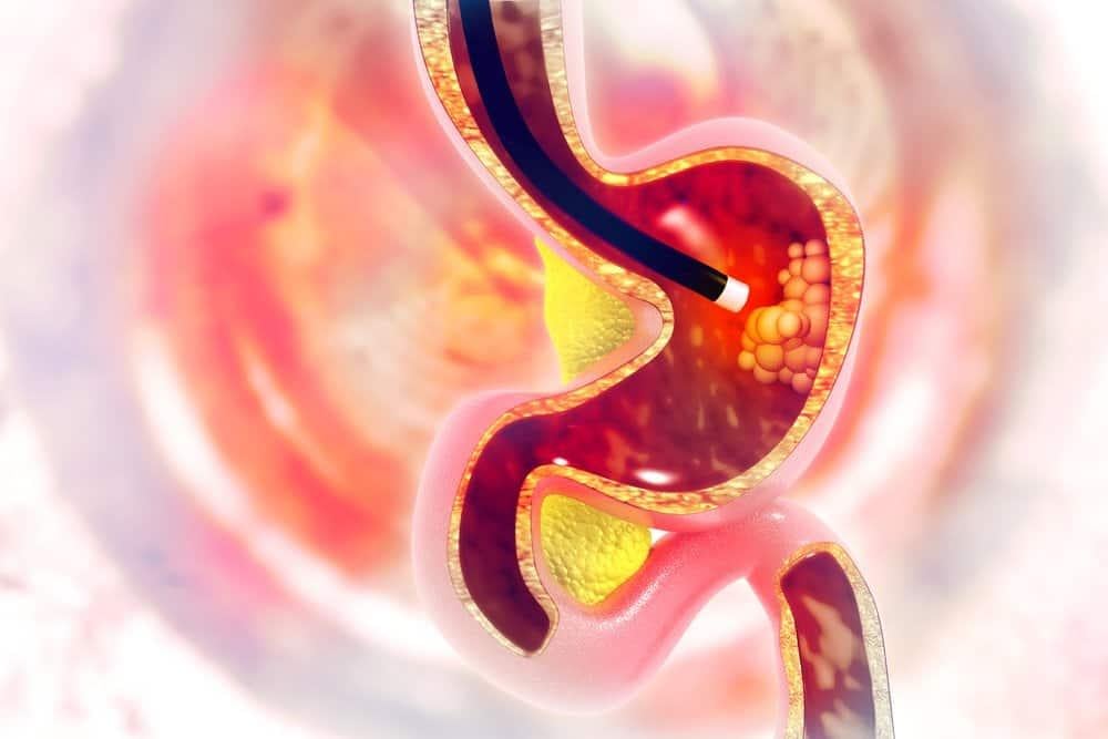 nhiễm vi khuẩn HP