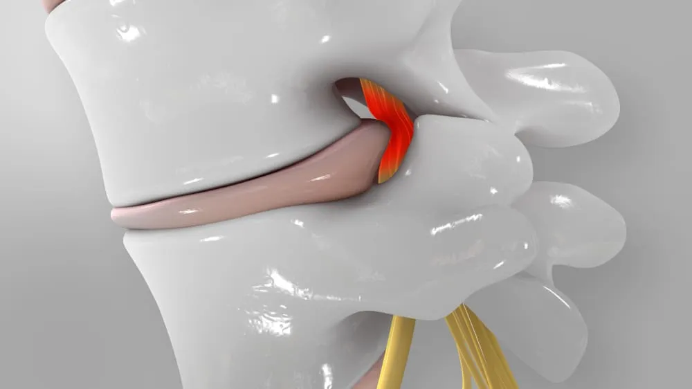 Những cách chữa chèn ép dây thần kinh