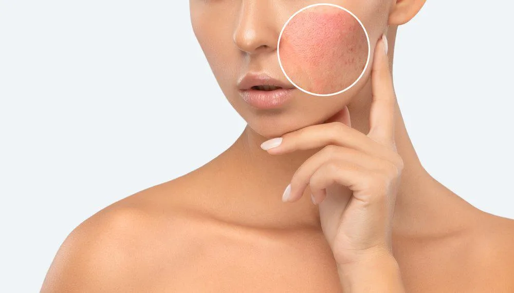 Trẻ hóa da bằng laser bóc tách