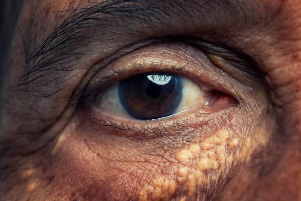 triệu chứng rối loạn lipid máu bên ngoài