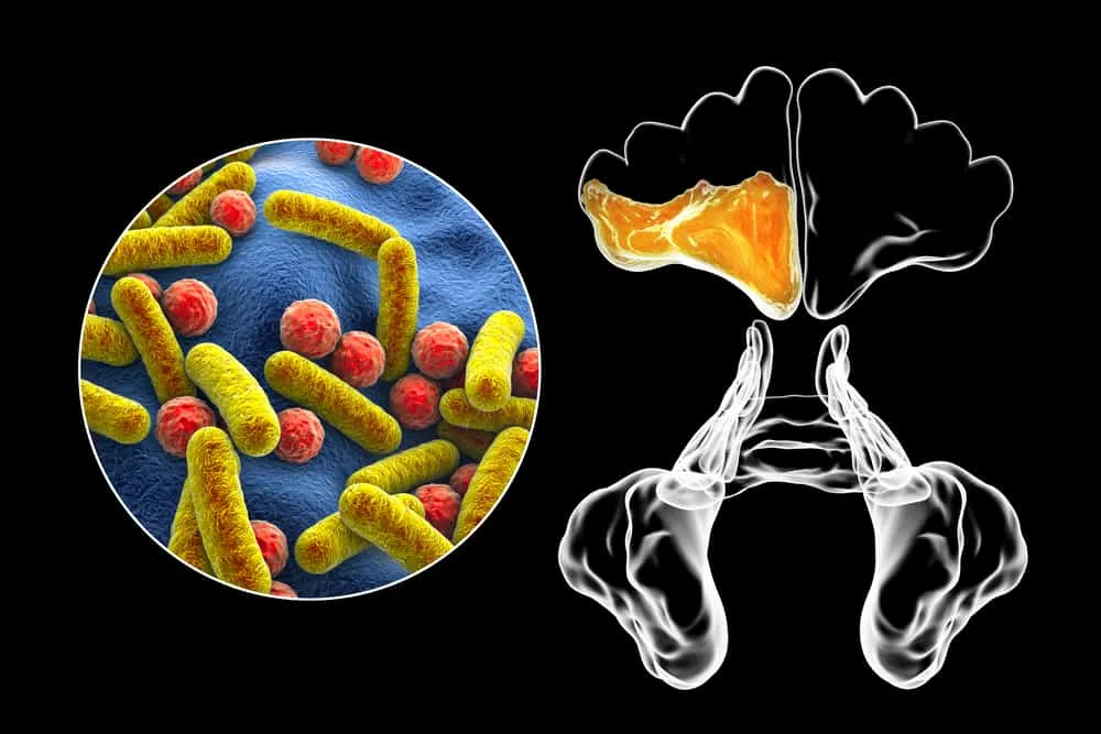 cách chữa viêm xoang có mủ