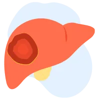 Sàng lọc hỗ trợ tầm soát ung thư gan