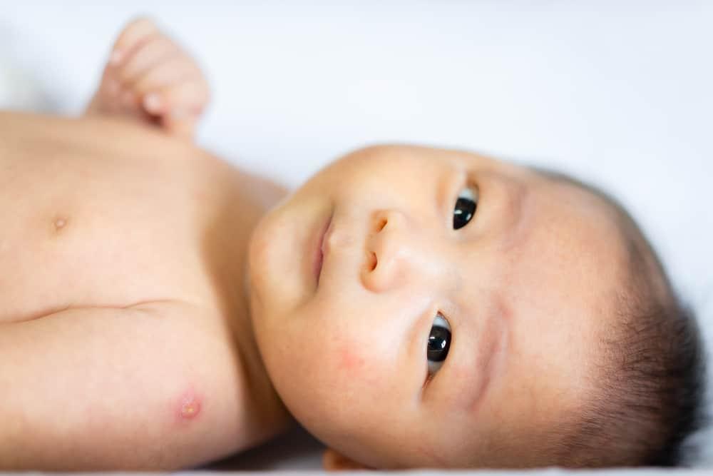 phản ứng tại vết tiêm sau khi trẻ chích ngừa