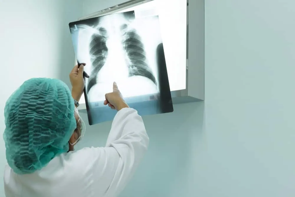 phẫu thuật điều trị ung thư phổi