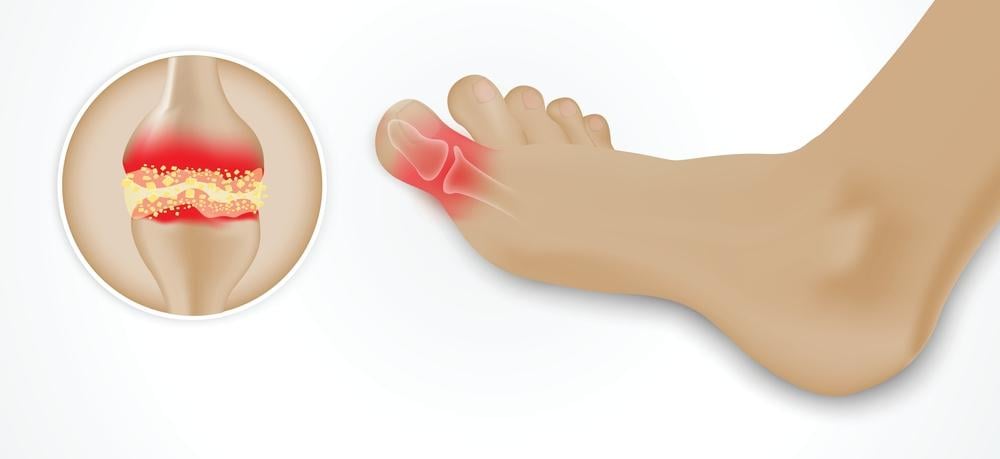 triệu chứng gout cấp