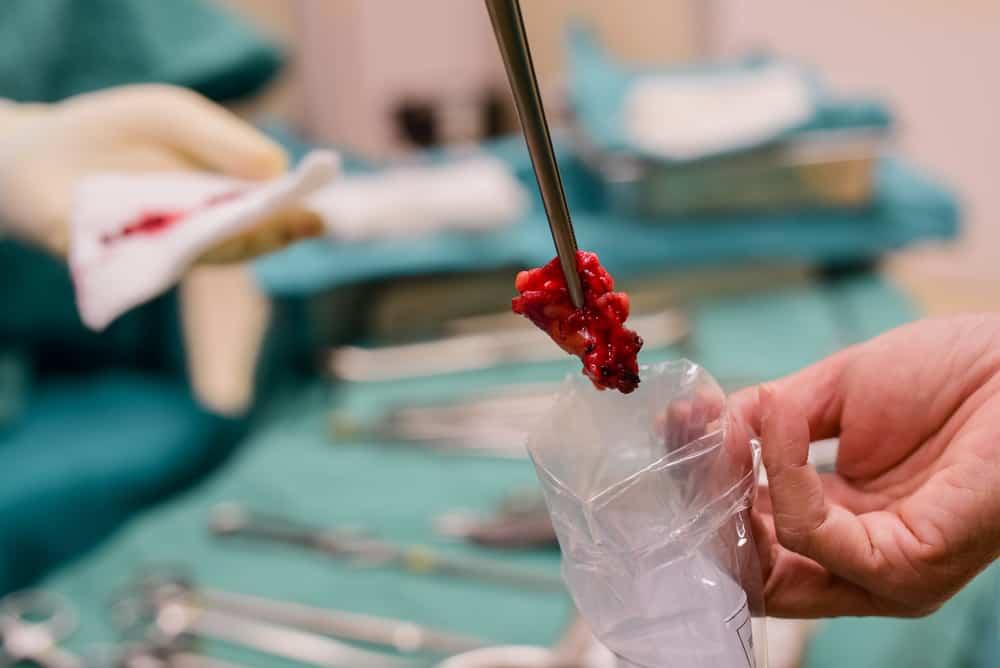 xét nghiệm ung thư bằng sinh thiết