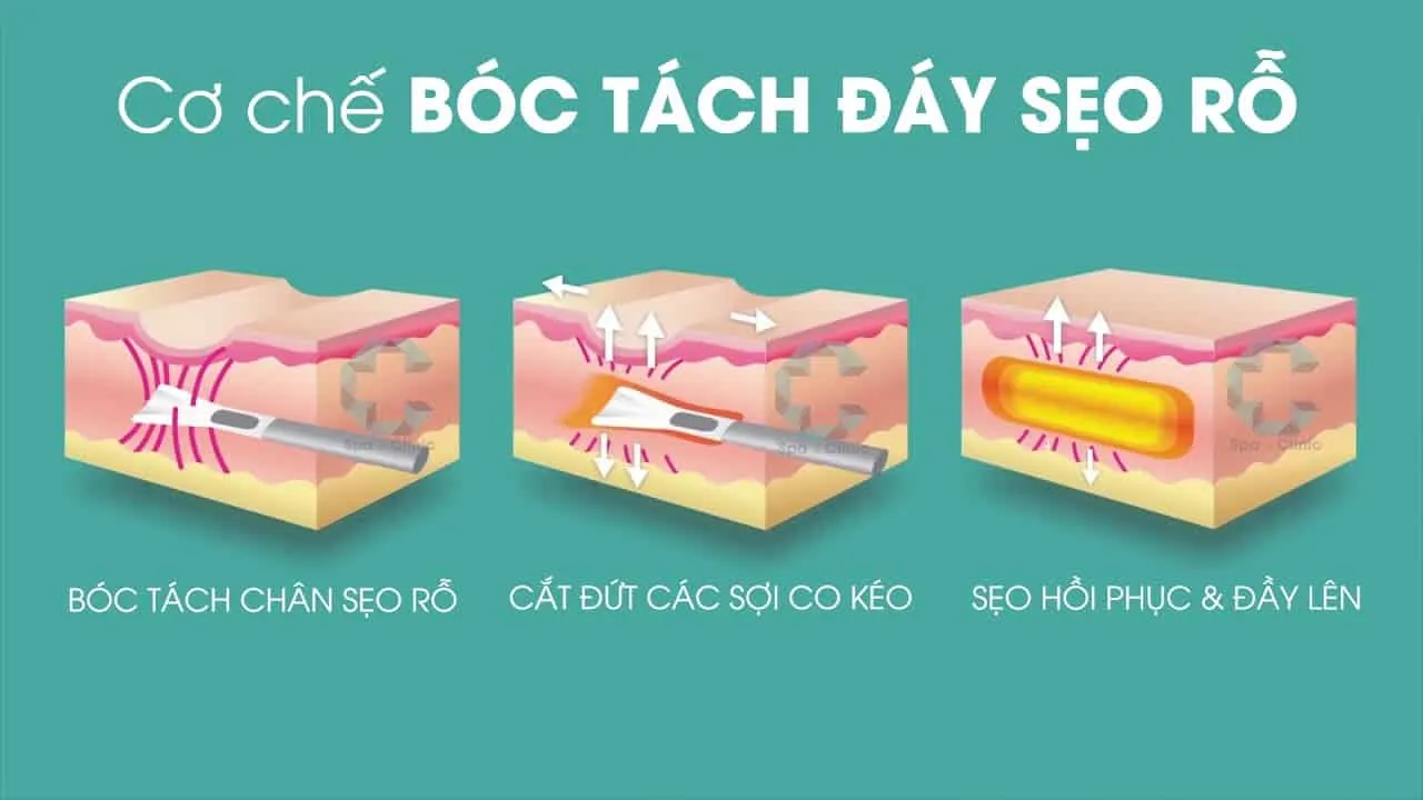  bóc tách sẹo