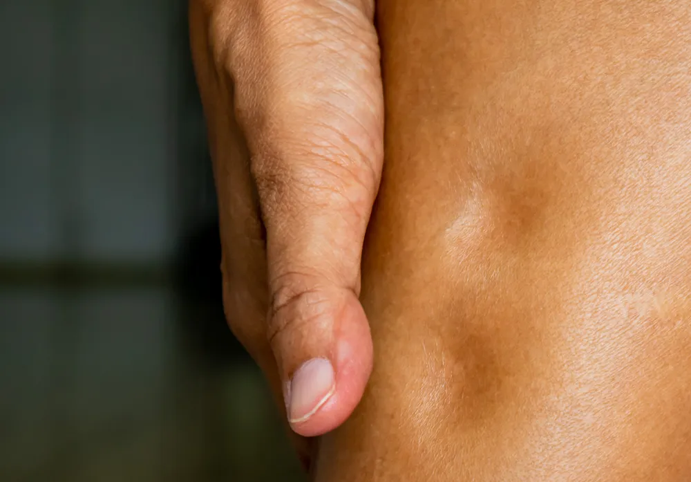 phù chân ở người già