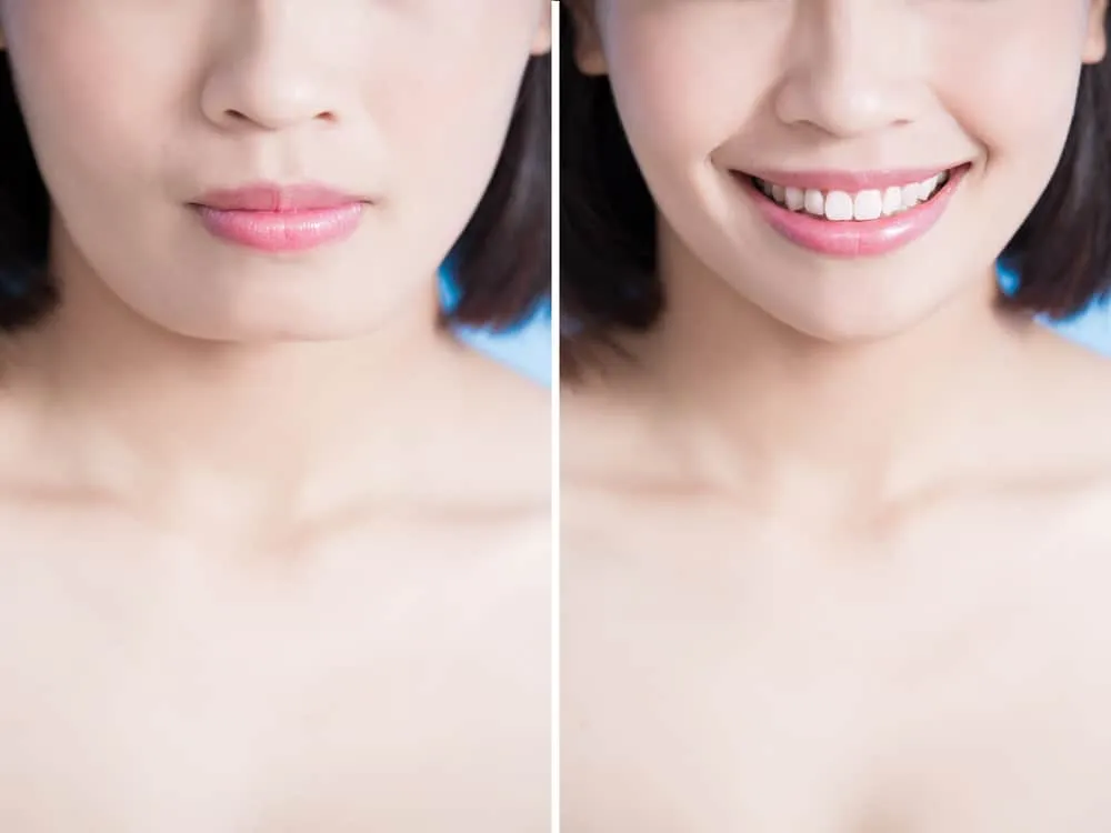 kết quả sau khi phẫu thuật chỉnh hàm