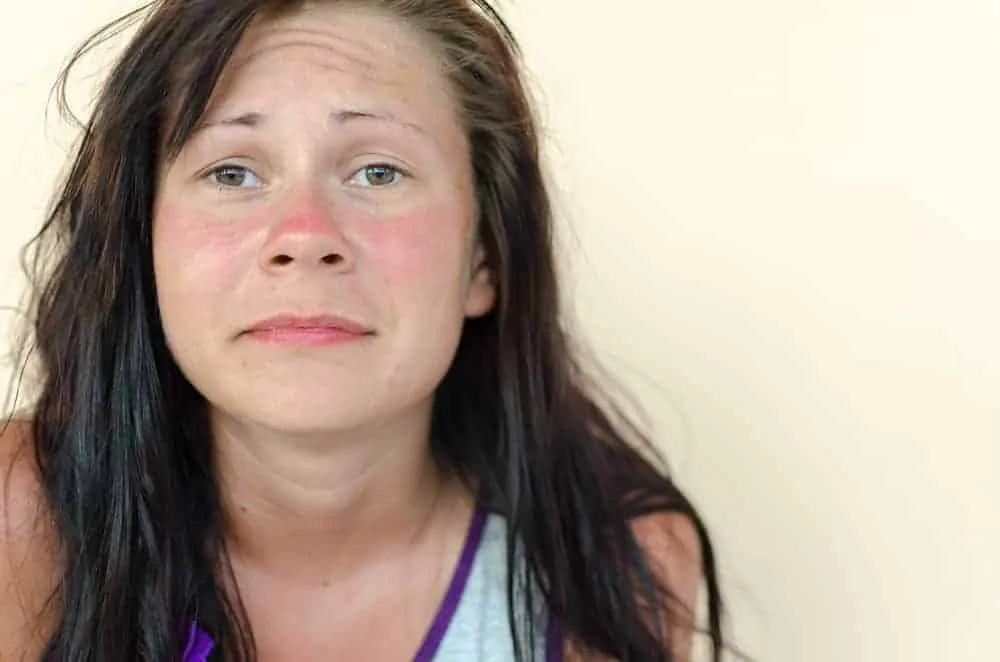 rửa mặt bằng chanh khiến da bị cháy nắng