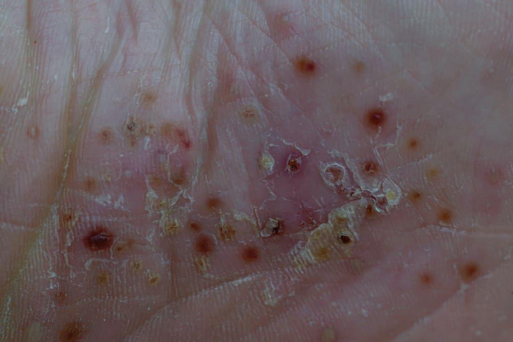 vảy nến thể mủ ở lòng bàn tay