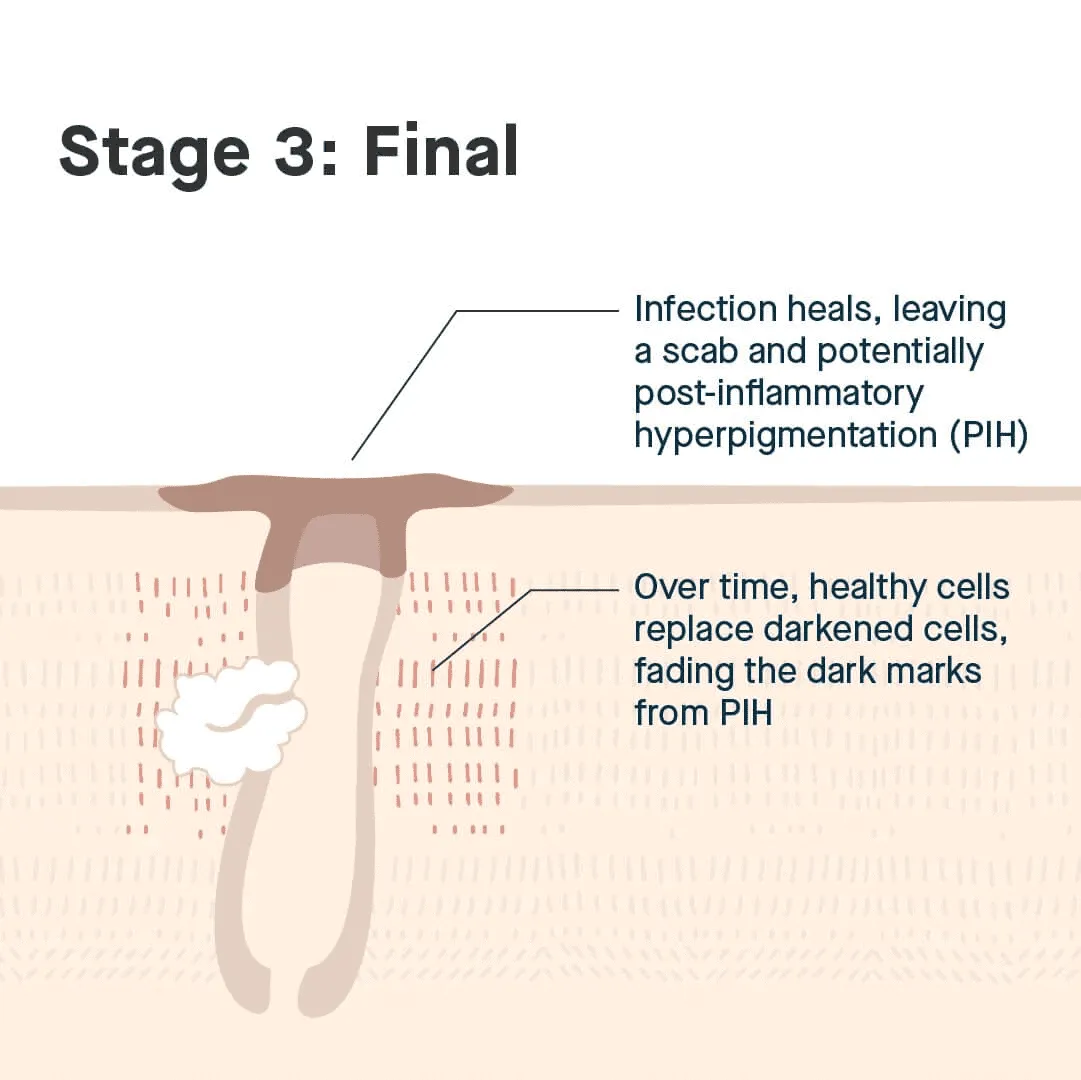 vòng đời của mụn