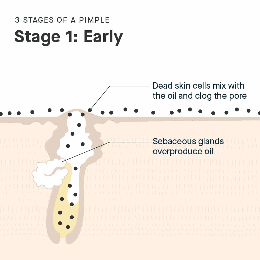 vòng đời của mụn: giai đoạn 1