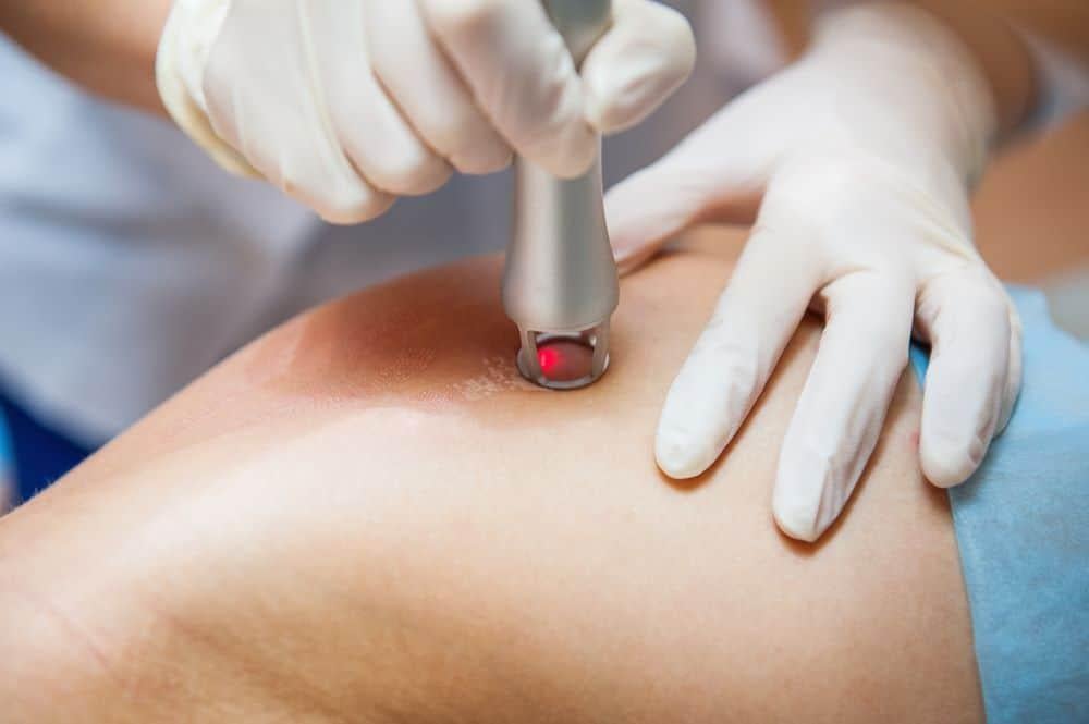 Sẹo thâm thủy đậu bao lâu thì hết: Điều trị bằng laser