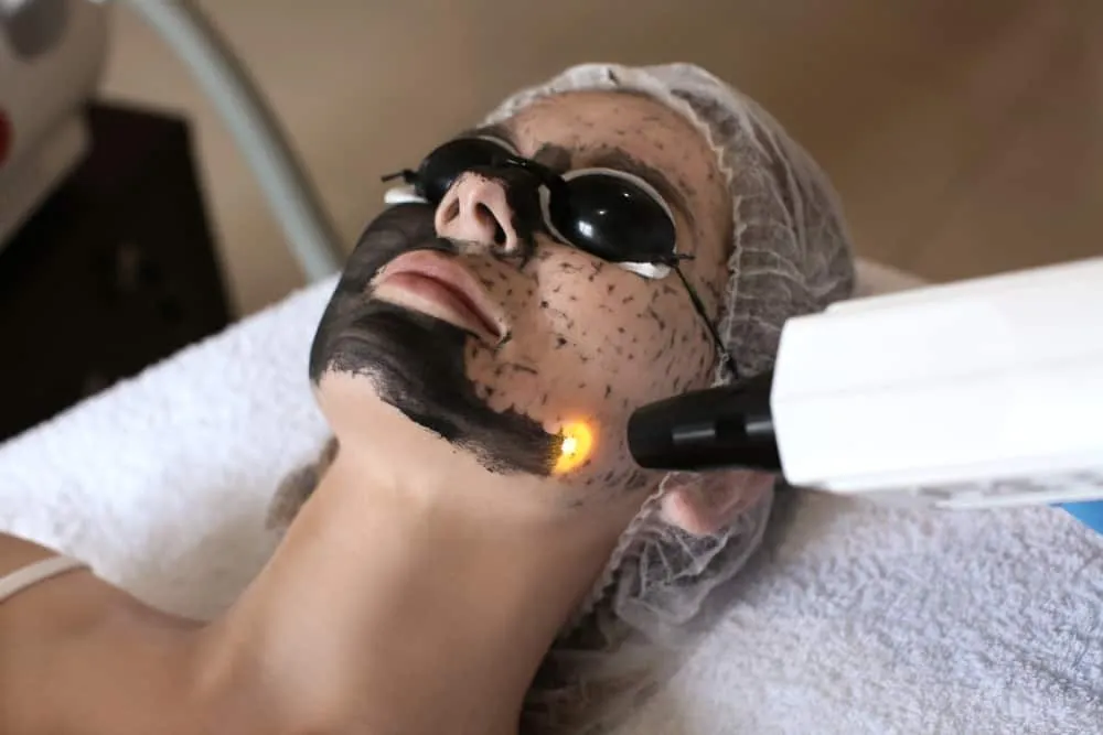 Quy trình thực hiện laser carbon peel