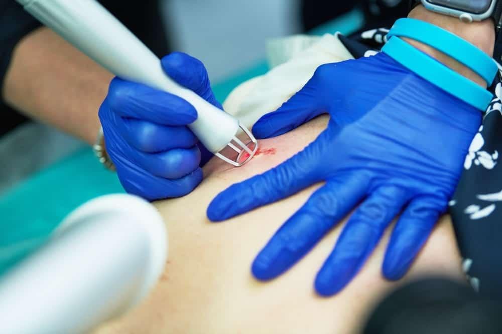 quy trình phẫu thuật thẩm mỹ xóa sẹo