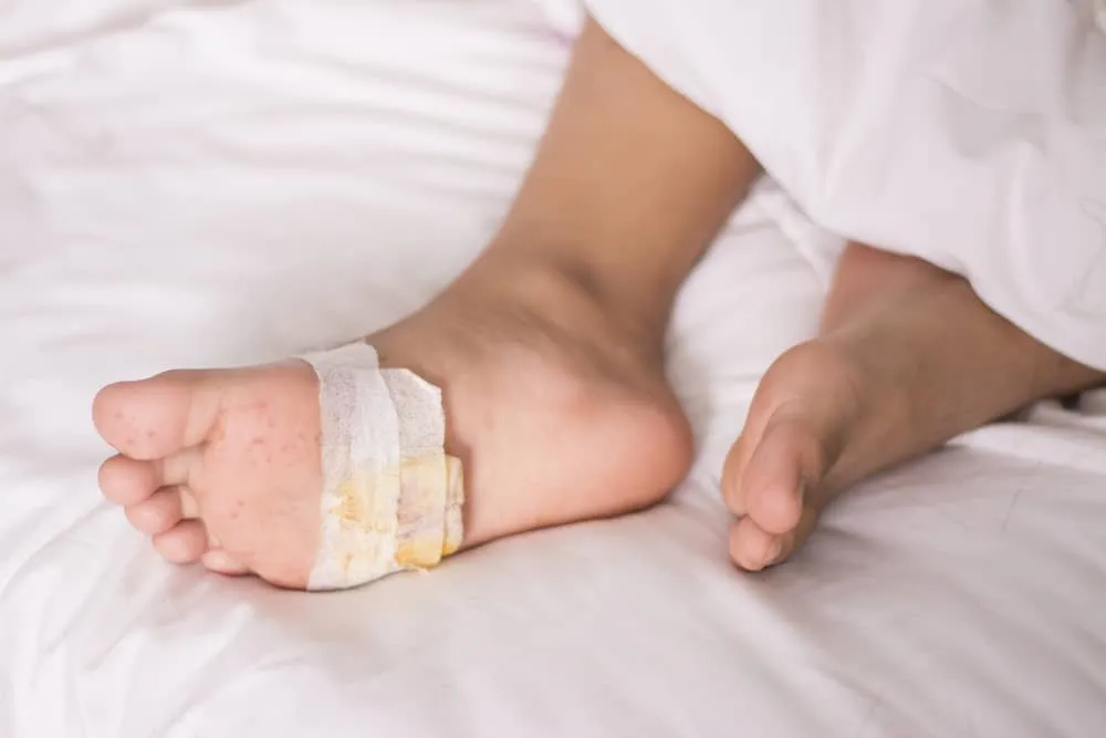 vết loét tiểu đường