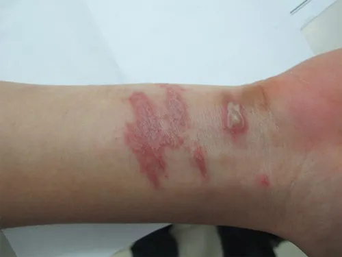 giải đáp bị bọ xít tiểu vào da bôi thuốc gì