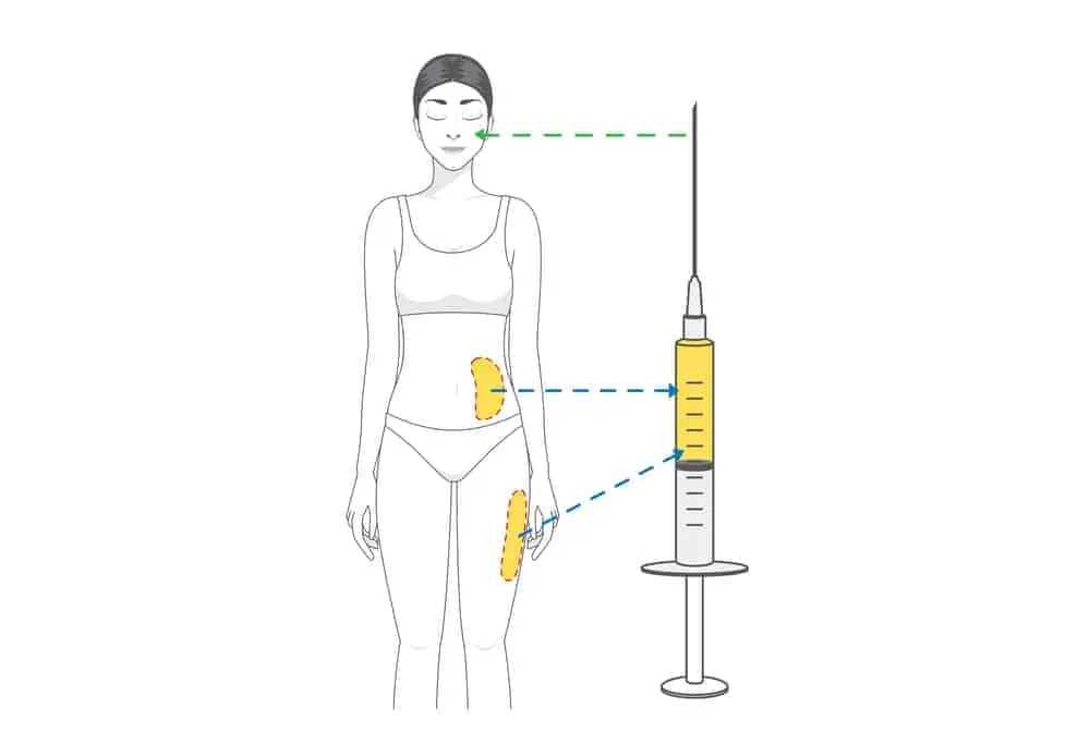 cấy mỡ tự thân