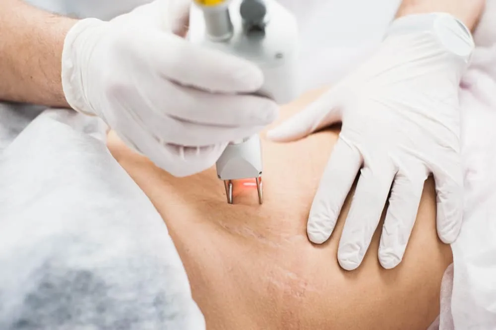 Điều trị rạn da