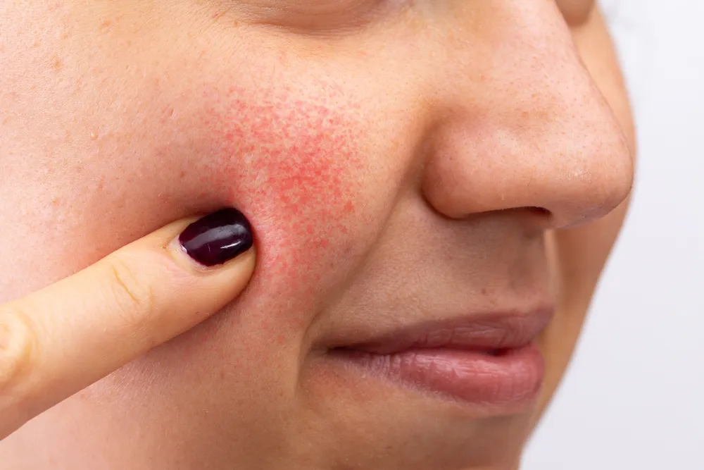 Tác dụng phụ của laser toning