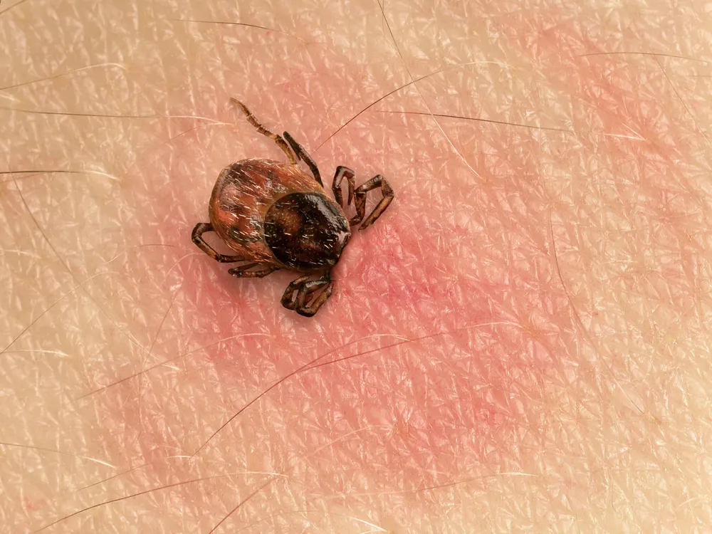 Bệnh Lyme là bệnh nhiễm trùng do bọ chét cắn